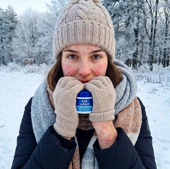 Piros foltok és viszketés a hidegben - Amikor nem csak száraz a bőr